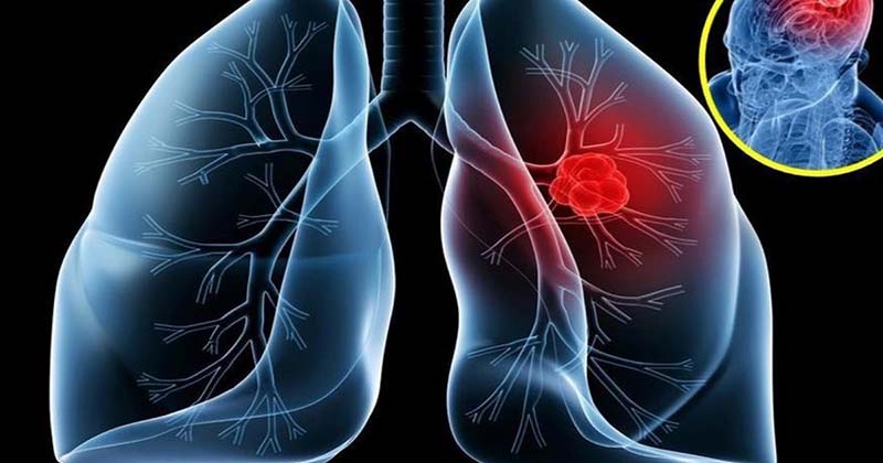Ung thư phổi di căn sống được bao lâu