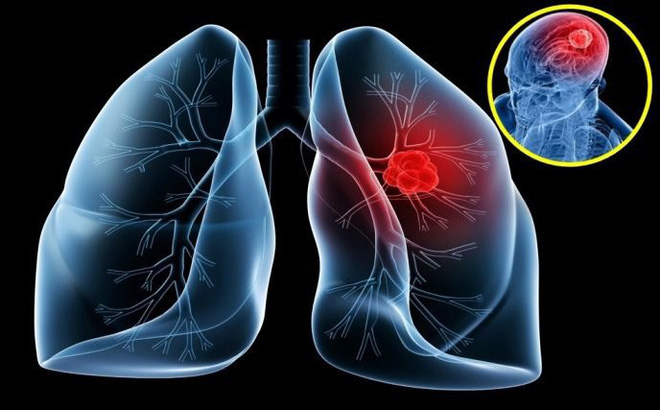 Ung thư phổi nên ăn quả gì tốt cho bệnh