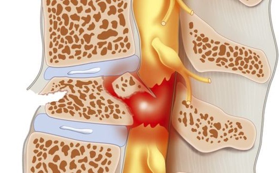 Ung thư tủy sống được bao lâu và cách phòng bệnh ra sao