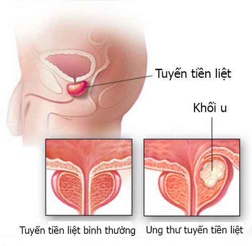 ung thư tuyến tiền liệt là gì cách phòng và điều trị bệnh