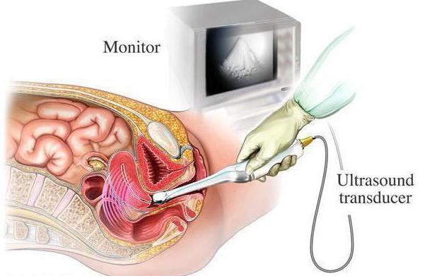 Ung thư tuyến tiền liệt sống được bao lâu và cách phòng bệnh như thế nào