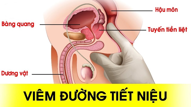 Viêm đường tiết niệu đau ở đâu