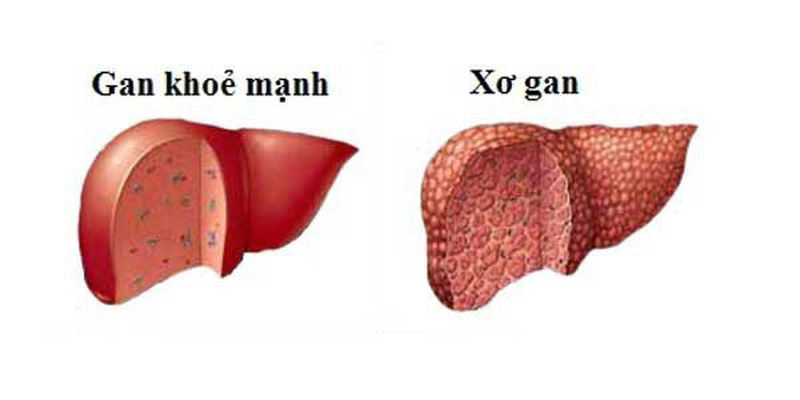 Viêm gan c có lây qua đường nước bọt không