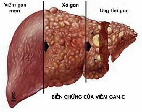 viêm gan C lây qua đường nào, cách phòng và điều trị bệnh ra sao