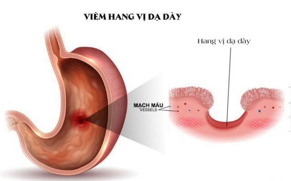 Viêm hang vị dạ dày