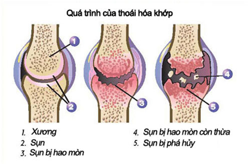 Viêm khớp gối uống thuốc gì tốt an toàn