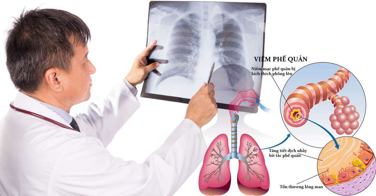 Viêm phế quản cấp tính có nguy hiểm không