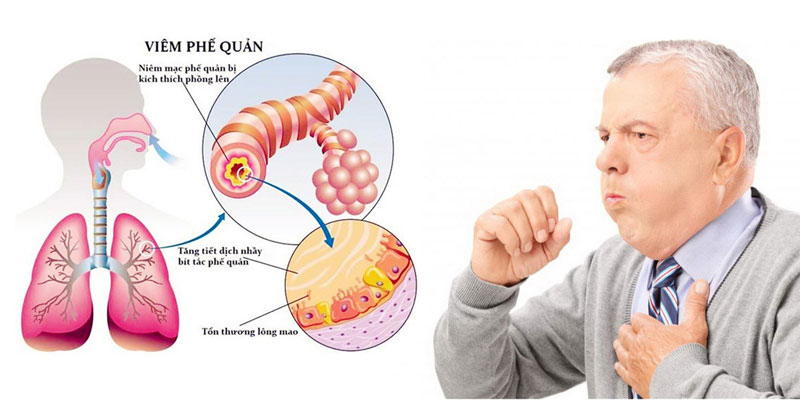Bệnh phổi tắc nghẽn mạn tính có chữa được không
