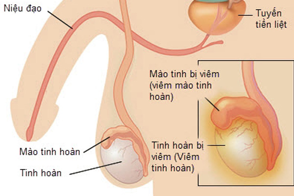 Viêm tiền liệt tuyến có nguy hiểm không và cách điều trị như thế nào