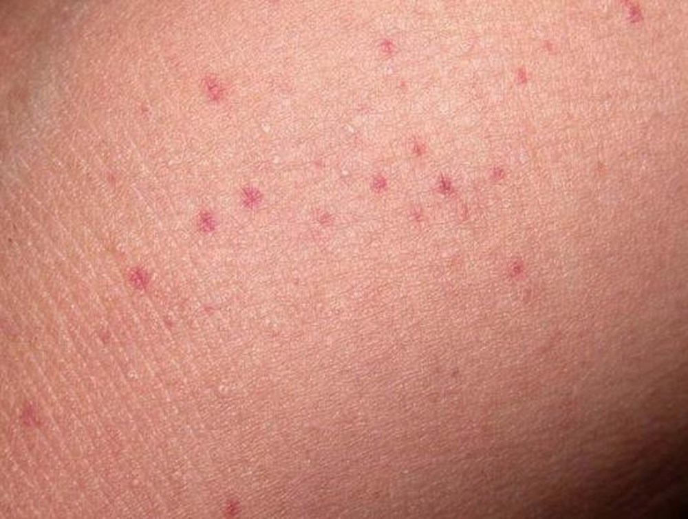 Virus viêm gan b lây qua đường nào và cách phòng bệnh ra sao