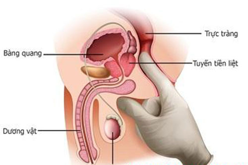 Vôi hóa tiền liệt tuyến là gì và cách chữa trị như thế nào