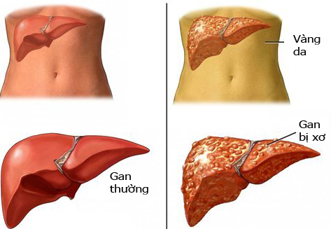 Xơ gan cổ trướng điều trị như thế nào