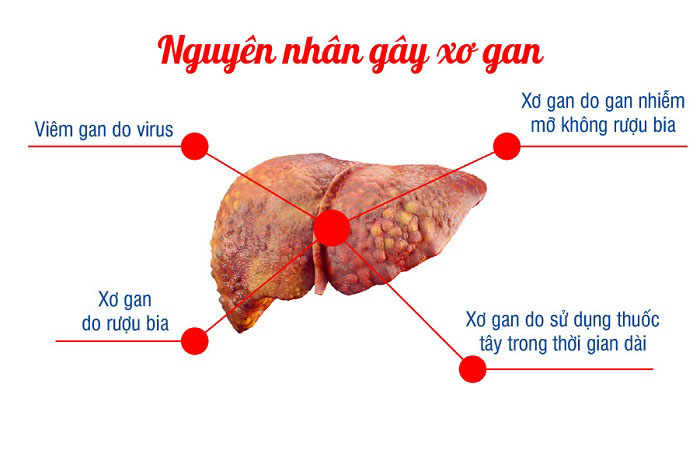 Xơ gan uống mật ong được không