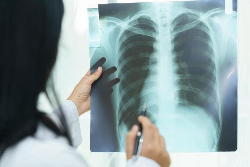 Xơ phổi có nguy hiểm không và cách điều trị ra sao