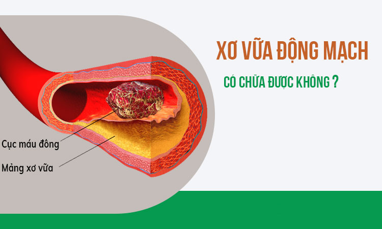 Xơ vữa động mạch có chữa được không