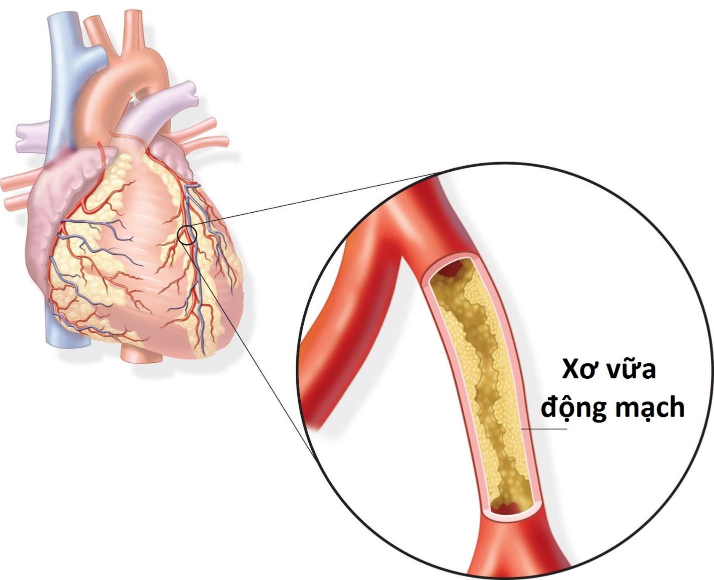 Xơ vữa động mạch có chữa được không