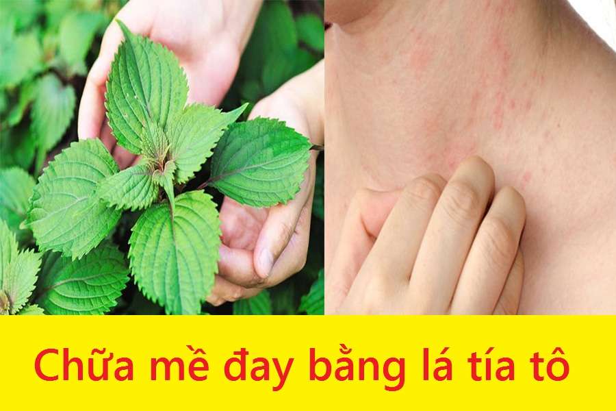 chữa mề đay bằng tía tô