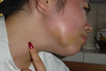 Điều trị răng khôn sai cách có thể gây nguy hiểm đến tính mạng?