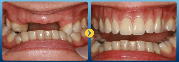 Trường hợp mất răng