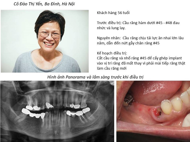 Trường hợp điển hình Implant thay thế chân răng hỏng do làm cầu răng lâu năm