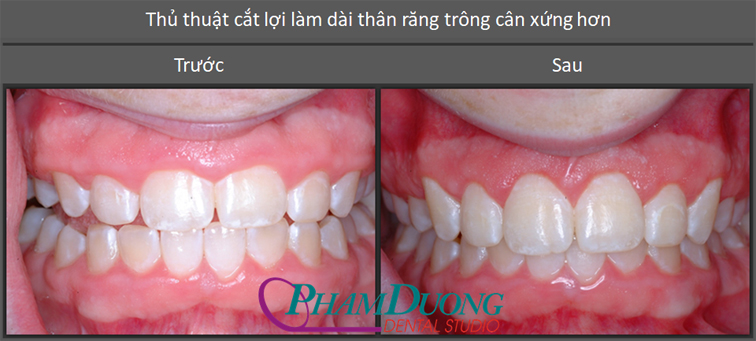 TẨY TRẮNG RĂNG