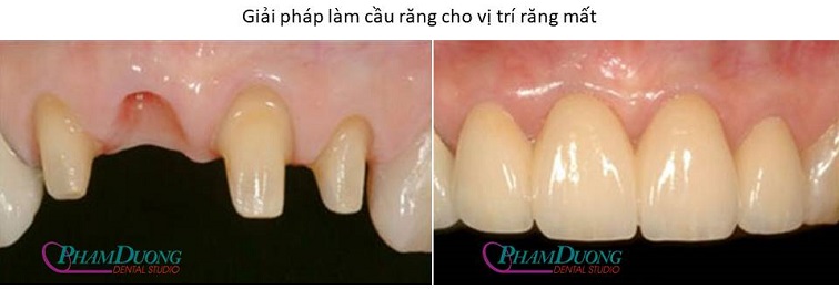 Giải pháp làm cầu răng