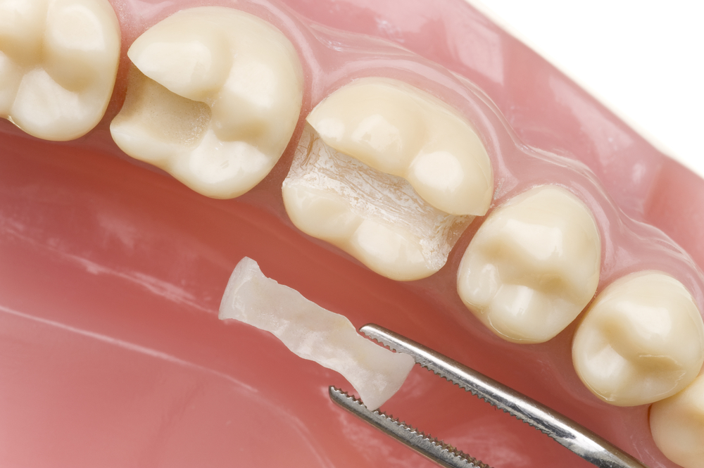 Kỹ thuật trám răng ngừa sâu răng hiệu quả ở trẻ nhỏ