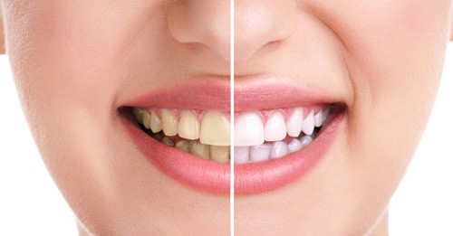 Răng nhiễm thuốc kháng sinh bị vàng răng nhẹ