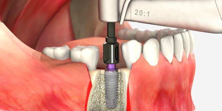 3 - Cấy trụ Implant
