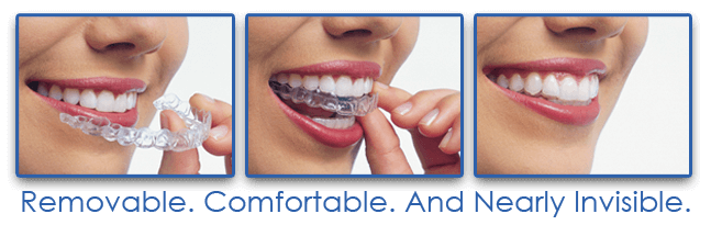 Chỉnh nha không mắc cài – Invisalign