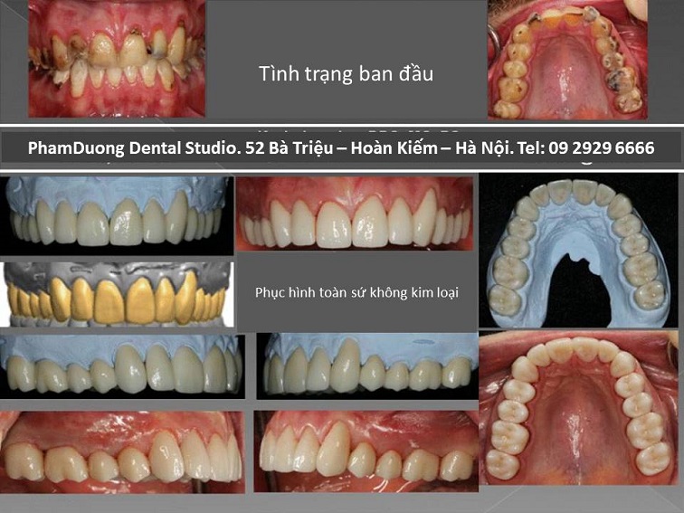 Phục hình cố định và tháo lắp