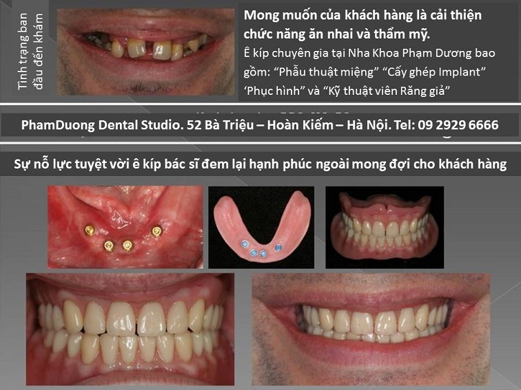 Phục hình tháo lắp