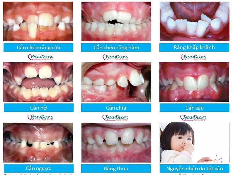 Chỉnh nha cơ chức năng là gì?
