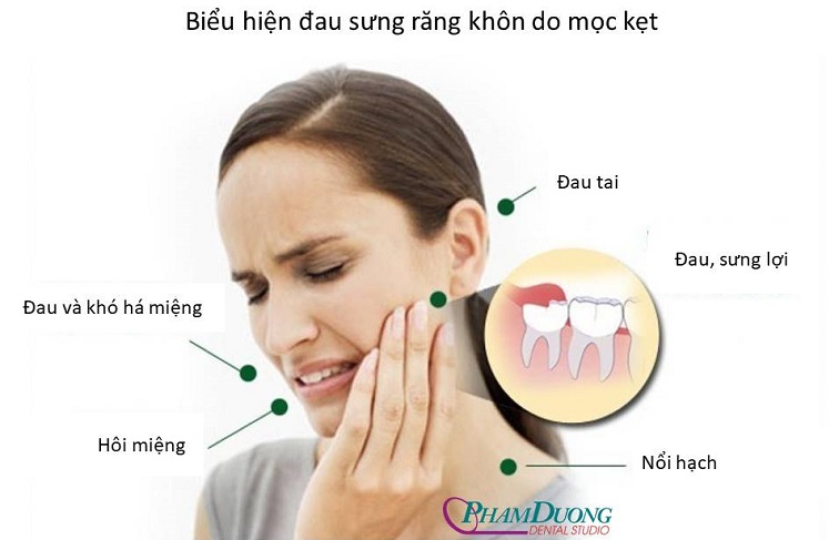 Biểu hiện đau răng khôn