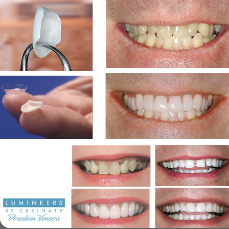 Răng nhiễm thuốc kháng sinh bị vàng răng nặng hơn