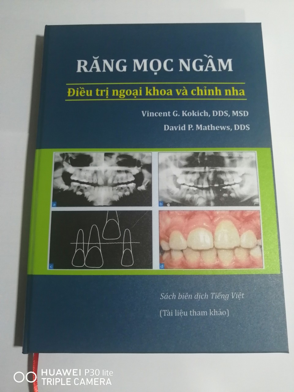 RĂNG MỌC NGẦM – PHẪU THUẬT CÙNG CHỈNH NHA