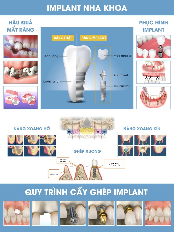 IMPLANT NHA KHOA