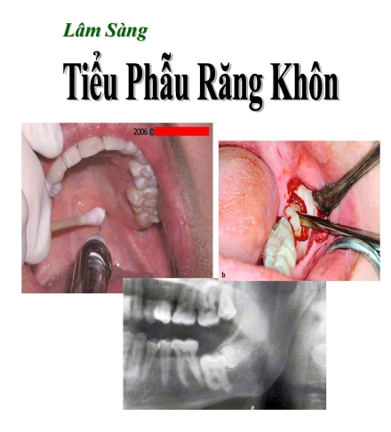 Sách Tiểu phẫu răng khôn