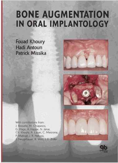 Sách bone AUGMENTATION IN ORAL IMPLANTOLOGY – FOUAD KHOURY,HADI ANTOUN,PATRICK MISSIKA – © 2007