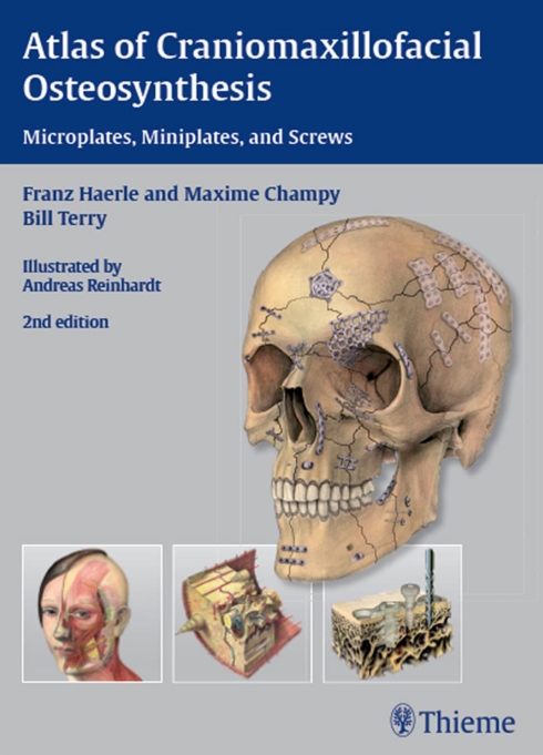 Sách Atlas of Craniomaxillofacial Osteosynthesis- Microplates, Miniplates, and Screws - Thieme_ 2 edition