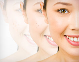 Tạm biệt vết thâm do mụn: Hai bước đơn giản để có làn da không tì vết!