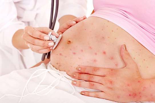 Rubella gây dị tật bẩm sinh