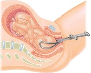 Các thủ thuật đặc biệt lúc sinh bé bạn nên biết trước
