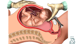 Mổ lấy thai – những điều bạn cần phải biết