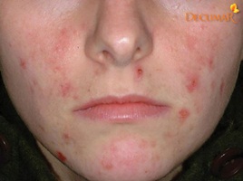 Trị sẹo do mụn - theo lời của chuyên gia da liễu