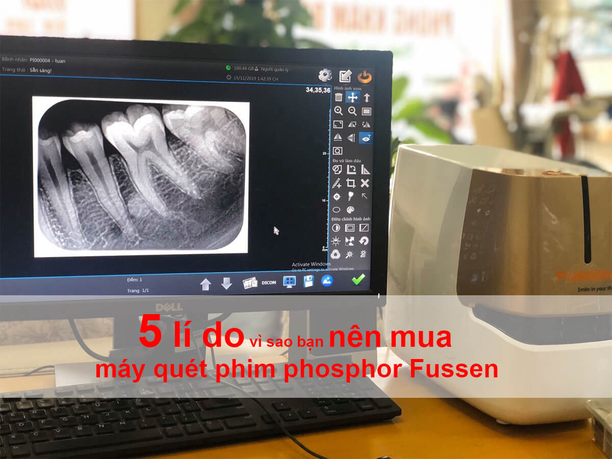 5 LÍ DO VÌ SAO BẠN NÊN MUA MÁY QUÉT PHIM PHOSPHOR FUSSEN