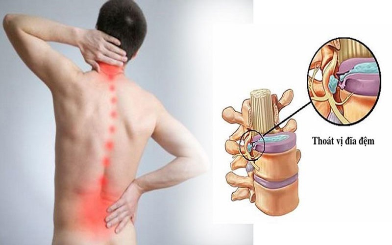 thoát vị đĩa đệm đốt sống cổ