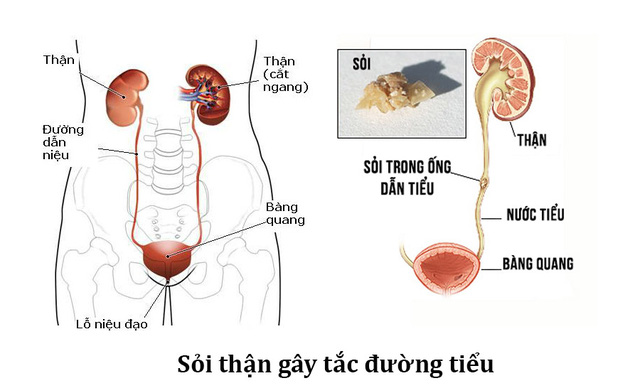 bệnh sỏi thận có nguy hiểm không và cách điều trị bệnh