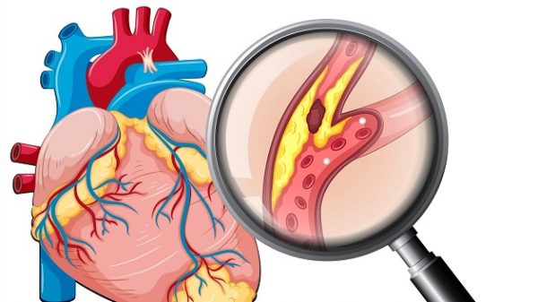 Nguyên nhân gây ra bệnh mạch vành là gì? Cách khắc phục như nào?