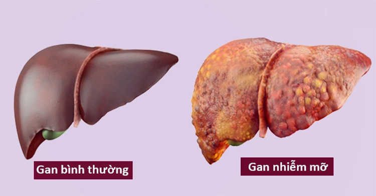 Gan nhiễm mỡ độ 1 có được coi là mức độ nguy hiểm không? Tìm hiểu ngay để biết